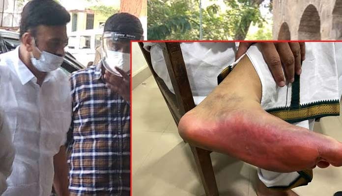 Speculations On Raghu Rama's Woonded Legs