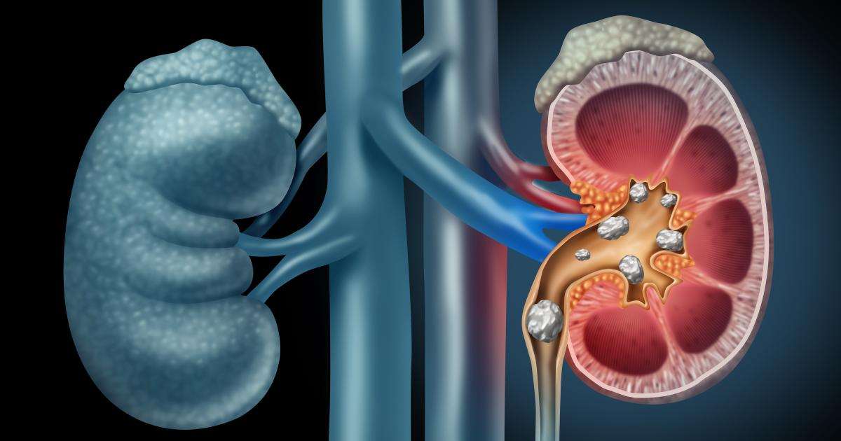kidney-stones-illustration
