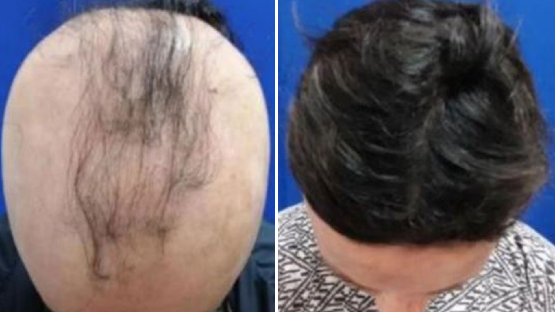 Hair Regrowth Tips On Bald Head Details Here Goes Viral In Social Media.webp